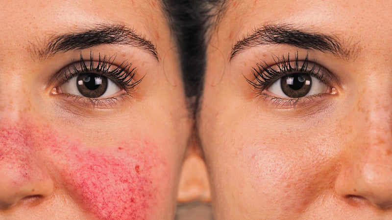 What is Rosacea, what causes Rosacea and how can you treat it?