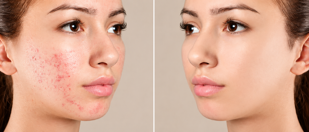 Before and After Results