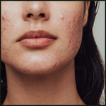 Detoxing Spot Serum 30ml | For Oily & Acne prone skin